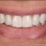 Achieving A Hollywood Smile With Cosmetic Dentistry